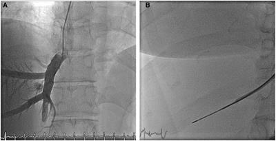 Routine follow-up transjugular liver biopsy in Fontan patients: technical considerations and safety of an initial case series and literature review